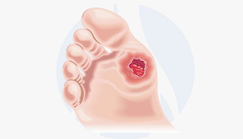 MARCELO-KALIL-PÉ-DIABÉTICO-INTERNA