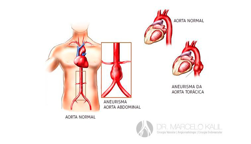 Imagem-aneurisma-da-aorta
