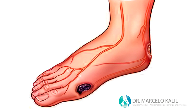 imagem-pe-diabetico-2