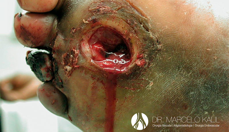 imagem-pe-diabetico-3