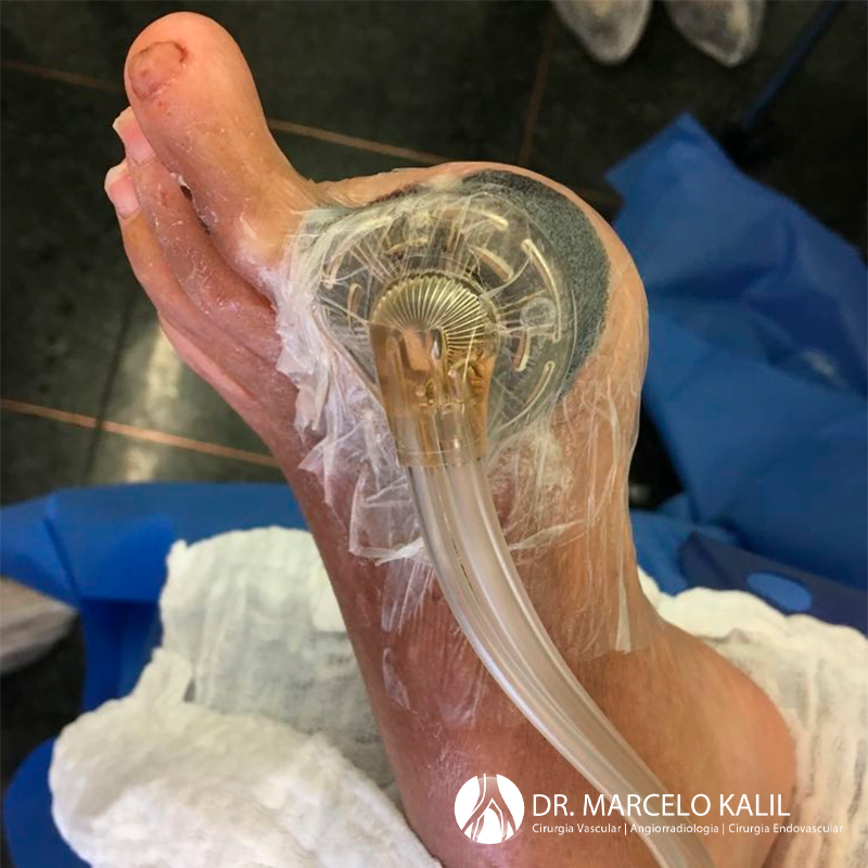 imagem-pe-diabetico-4