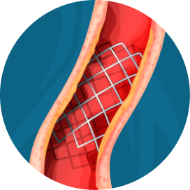 imagem thumb angioplastia marcelo kalil