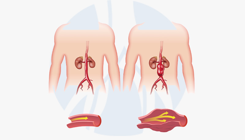 MARCELO-KALIL-Aneurisma-da-Aorta-Abdominal -INTERNA