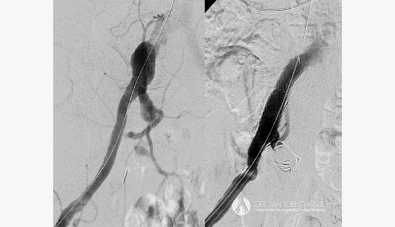 Imagem-Aneurisma-de-Artéria-Ilíaca-2