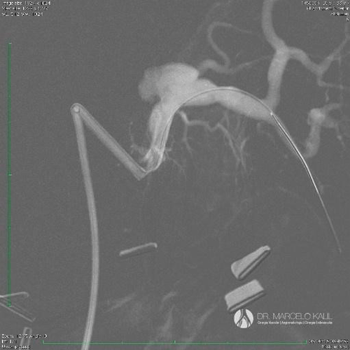 Imagem-Aneurismas-Viscerais-2