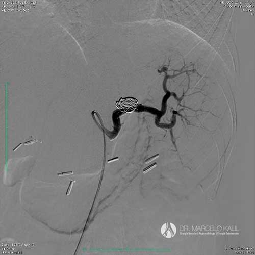 Imagem-Aneurismas-Viscerais-3