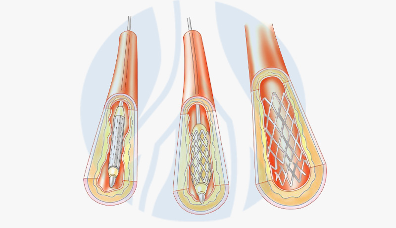 MARCELO-KALIL-ANGIOPLASTIA-INTERNA