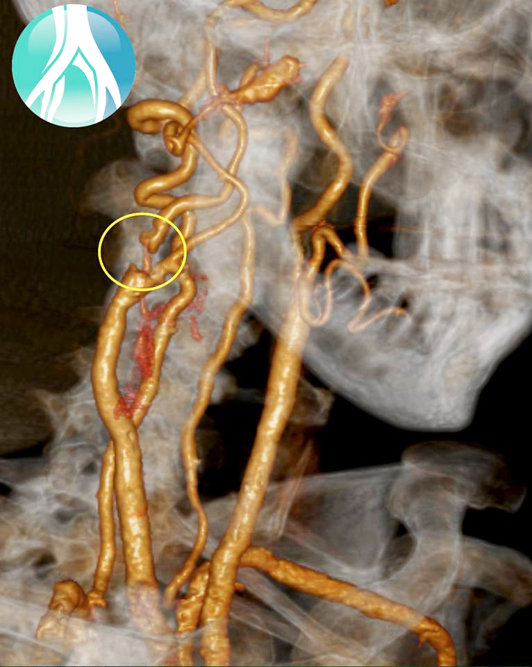 MARCELO-KALIL-DOENÇA-DA-CARÓTIDA-INTERNA