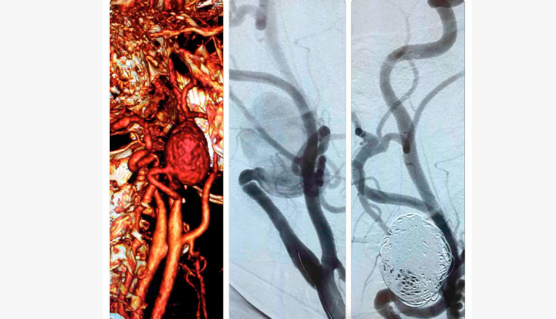 MARCELO-KALIL-Embolização-de-mioma-uterino-INTERNA1