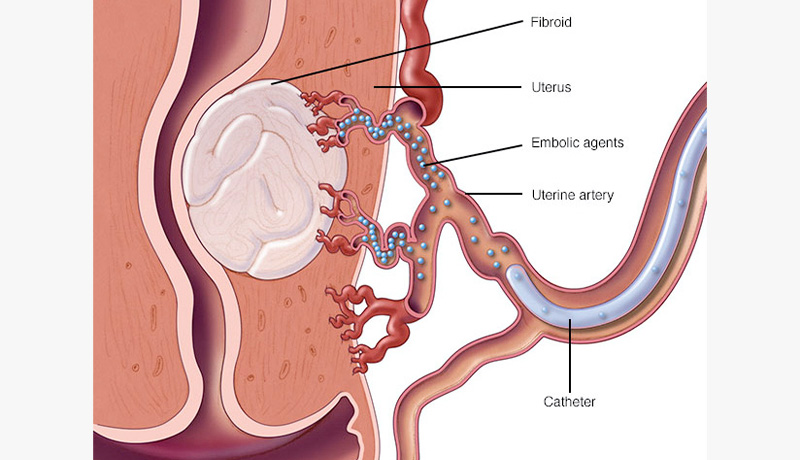 MARCELO-KALIL-Embolização-de-mioma-uterino2-INTERNA