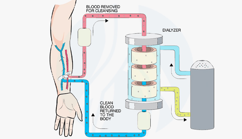 MARCELO-KALIL-FÍSTULA-PARA-HEMODIÁLISE-INTERNA1