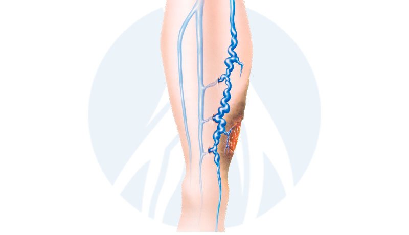MARCELO-KALIL-ÚLCERAS-VENOSAS-INTERNAOFICIAL MARCELO-KALIL-ÚLCERAS-VENOSAS-INTERNA3
