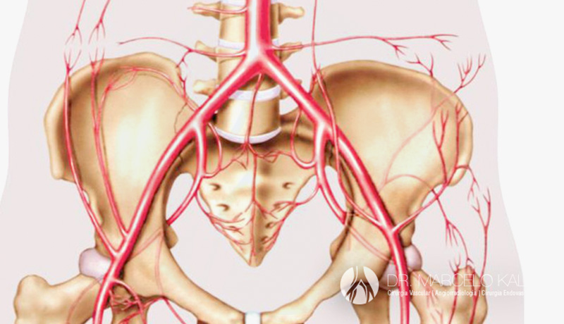 MARCELO-KALILAneurisma-de-artéria-ilíaca-INTERNA