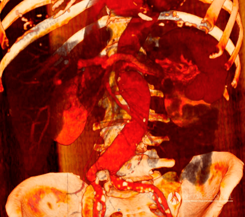 aneurisma-da-aorta-abdominal-1