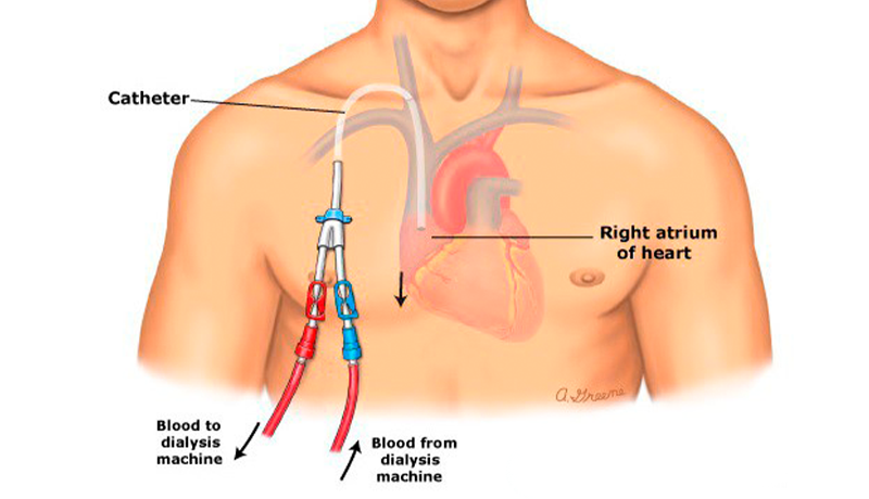 imagem-cateter-para-hemodiálise-2