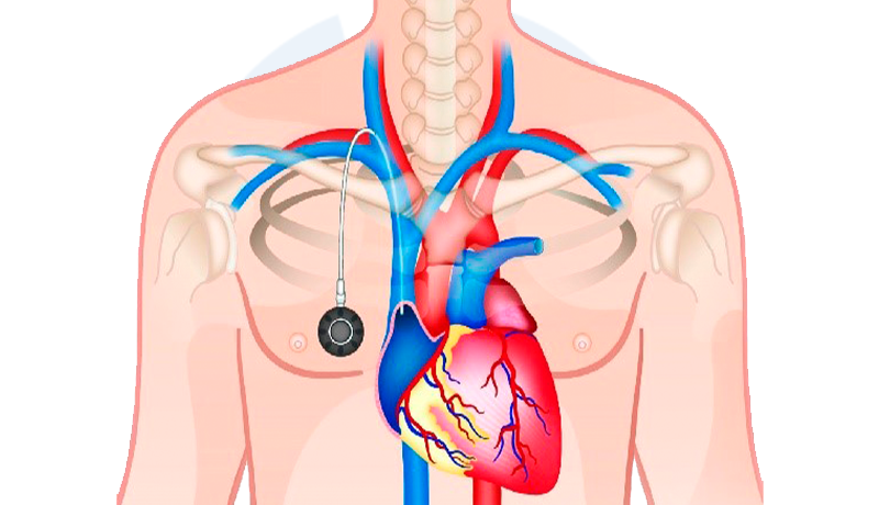imagem-cateter-para-quimioterapia-2