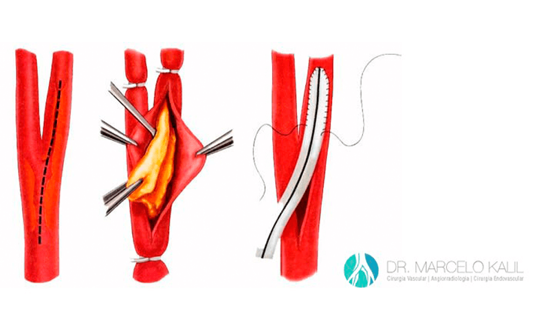 MARCELO-KALIL-DOENÇA-DA-CARÓTIDA-INTERNA