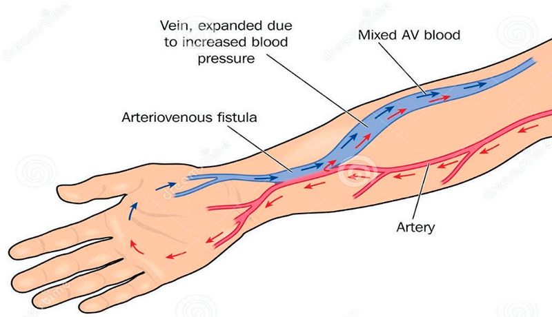 imagem-fistula-para-hemodiálise