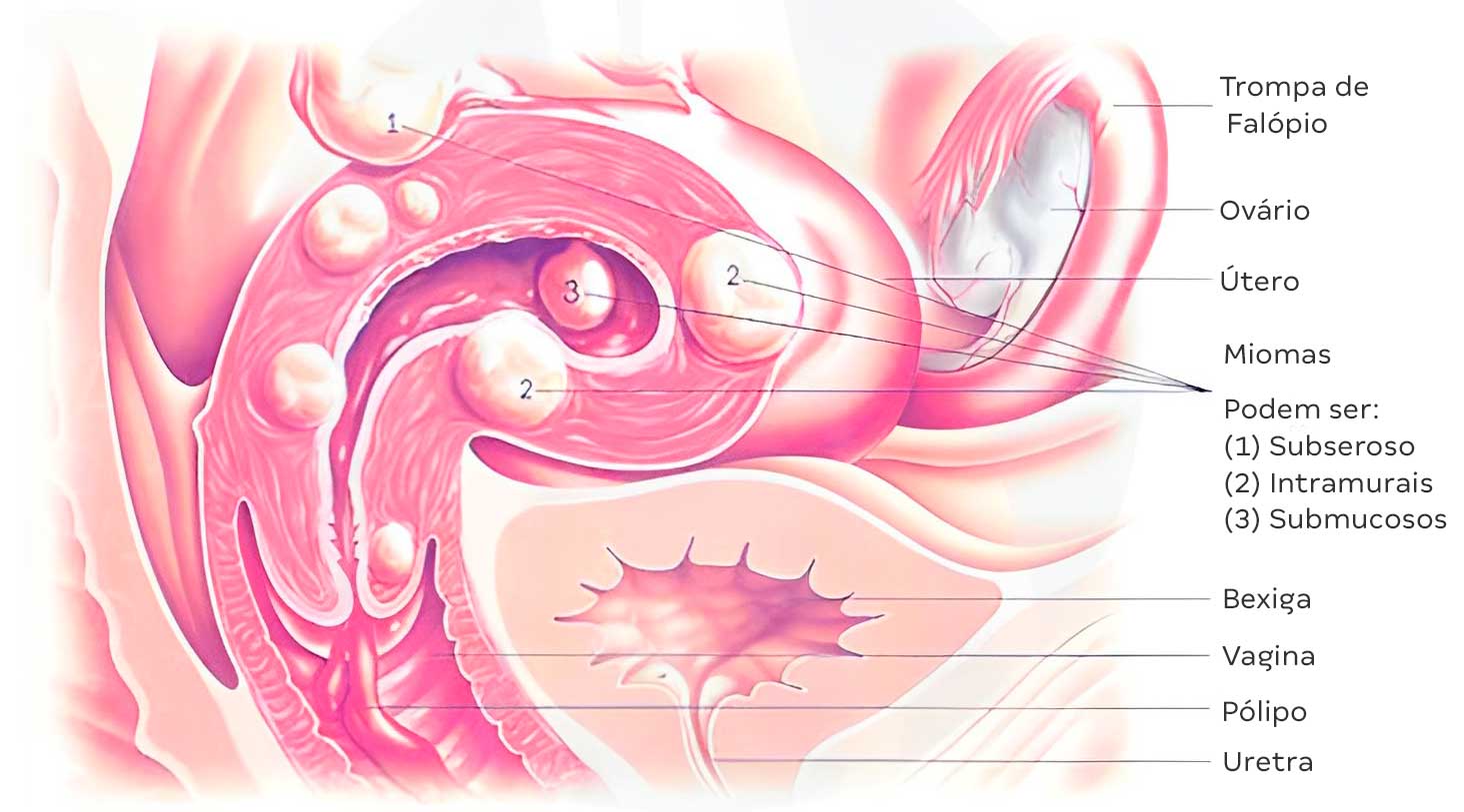 MARCELO-KALIL-Embolização-de-mioma-uterino-INTERNA