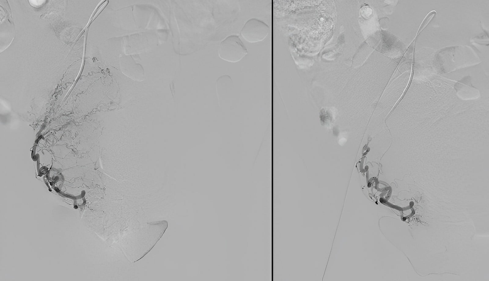 MARCELO-KALIL-Embolização-de-mioma-uterino3-INTERNA
