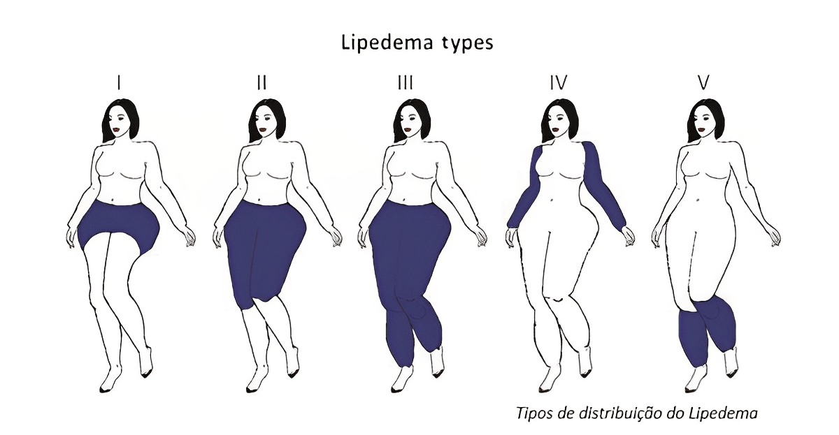 imagem 3 lipedema