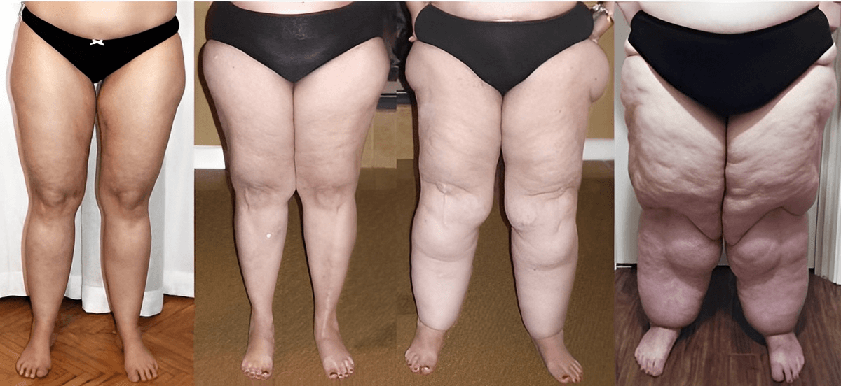 imagem 4 lipedema