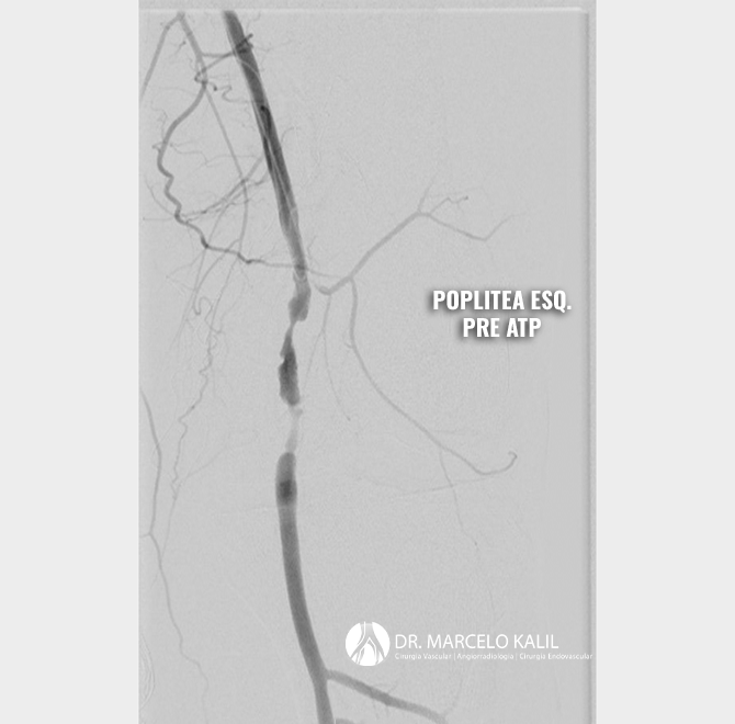 imagem-angioplastia-com-stent-e-doenca-aterosclerotica-2
