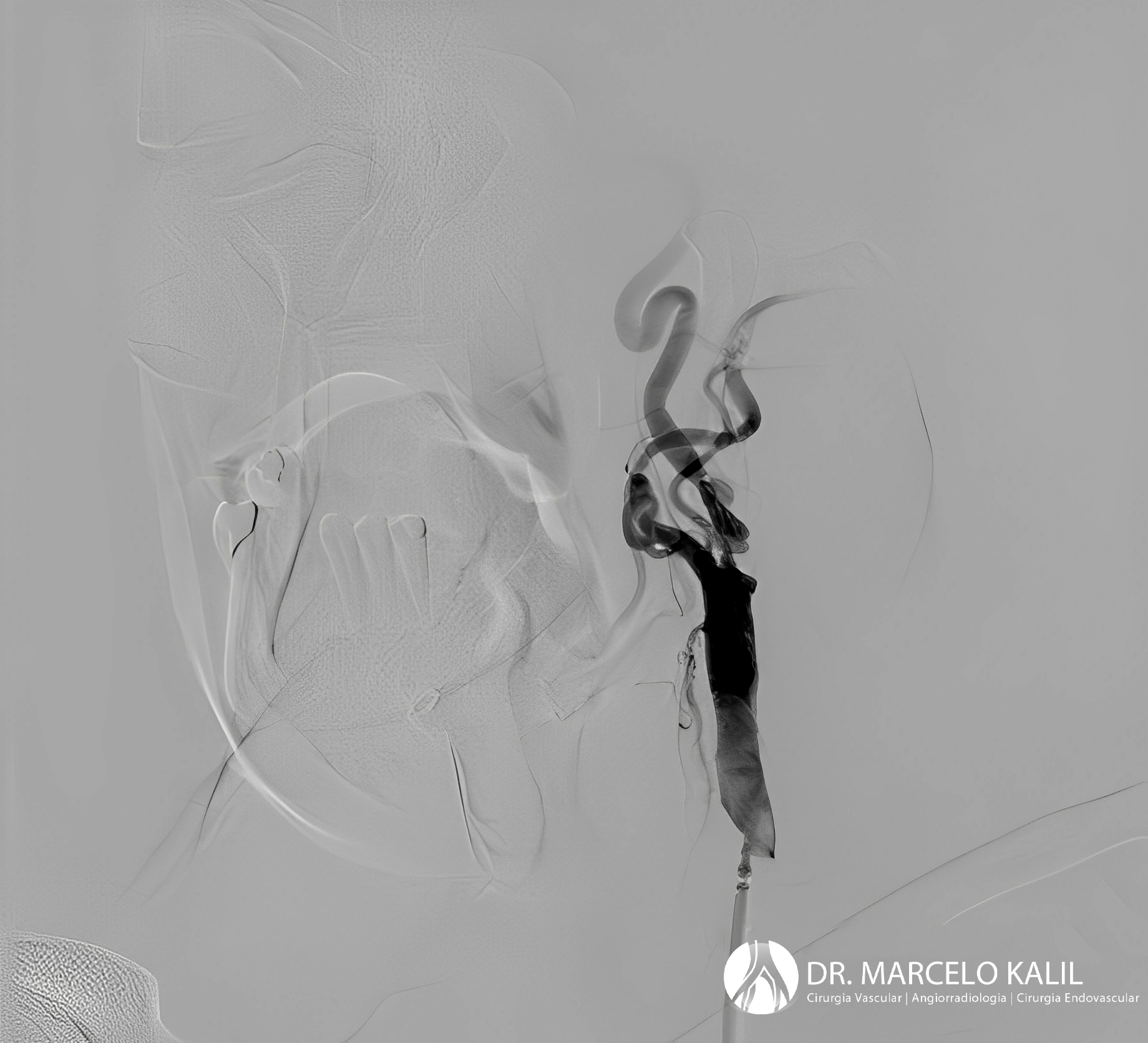 imagem-doença-da-carotida-3