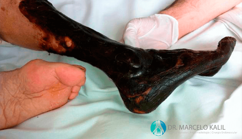 imagem-obstrução-arterial-2