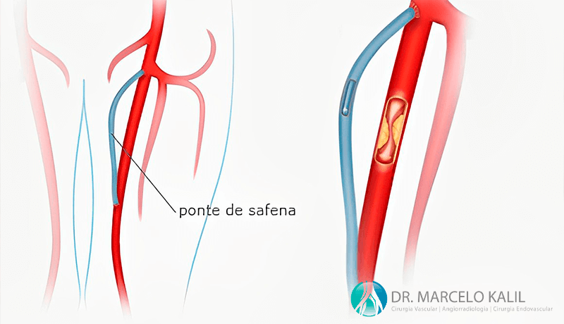 imagem-obstrução-arterial-3
