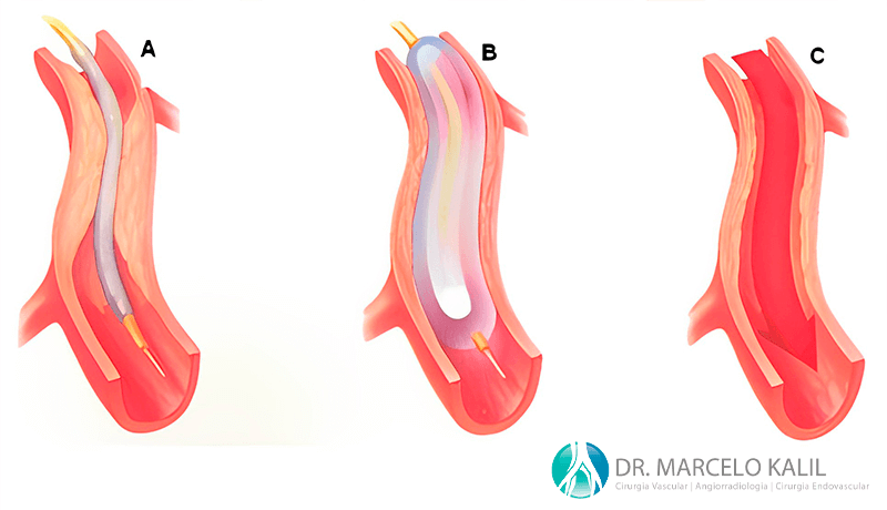 imagem-obstrução-arterial-2