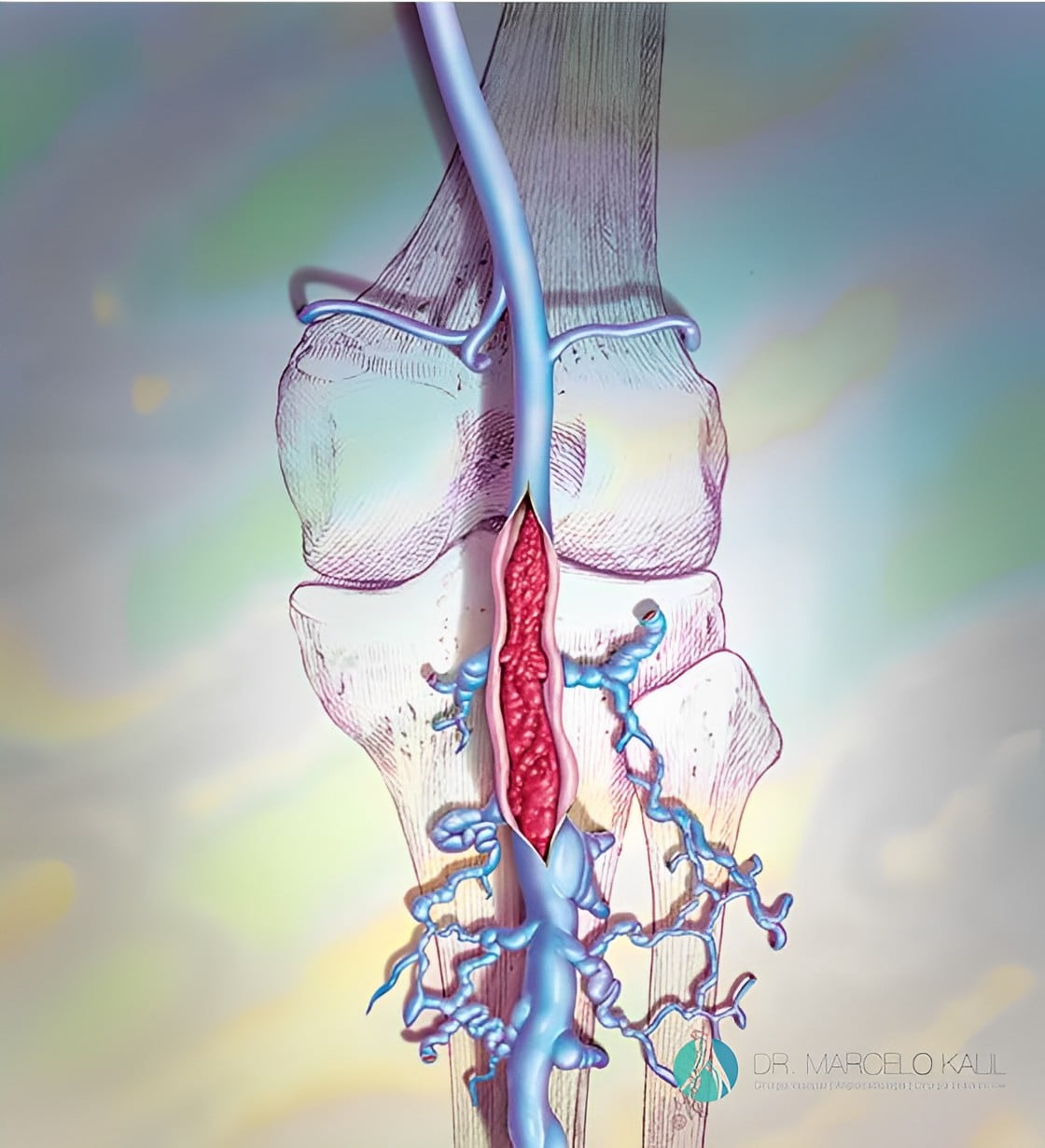 imgem trombose venosa profunda 2
